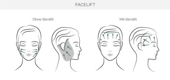 Grafik Facelift, Gesichtschirurgie München, Dr. Jacobi
