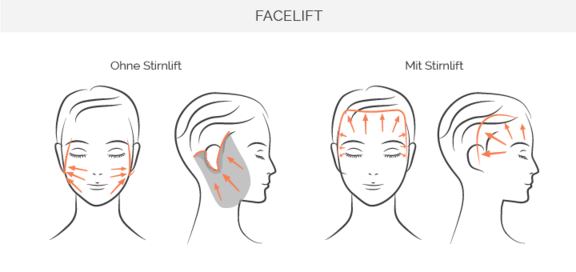 Facelift, Gesichtschirurgie München, Dr. Jacobi